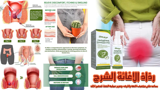 رذاذ علاج البواسير